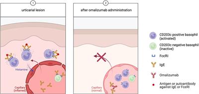The Potential Role of Basophils in Urticaria
